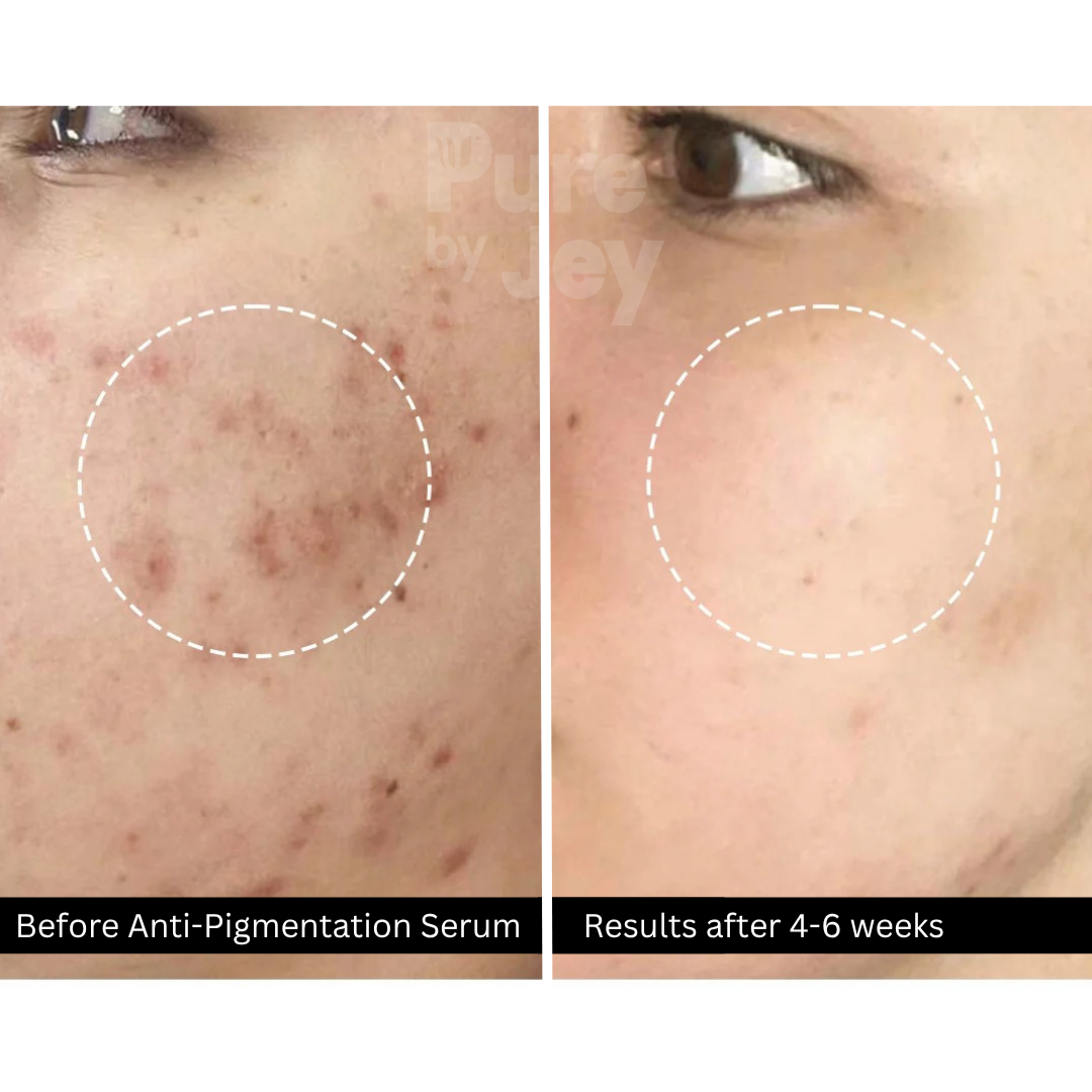 Anti-Pigmentation Serum -  5% Vit C, 2% Kojic Acid + 5% Mandelic Acid
